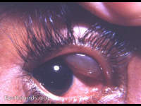 conjunctival cyst: huge