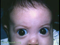 epiblepharon with megalocornea