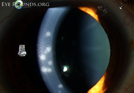 Epidemic (adenoviral) keratoconjunctivitis