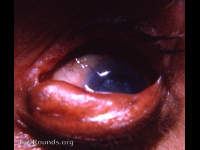 epidermalization of palpebral conjunctiva