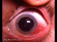 episcleritis