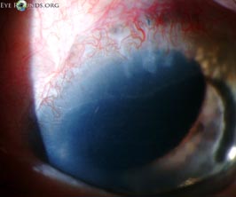 epithelial downgrowth