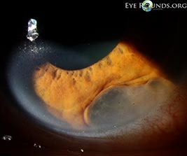 epithelial inclusion cyst