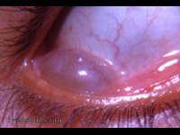 conjunctiva: epithelial inclusion cyst - inferior fornix