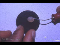 Bell microerisiphake with Morgagnian cataract