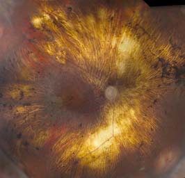 Erosive vitreoretinopathy