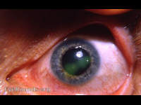 dendritic keratitis: after being scrubbed with ether on a q-tip