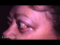 malignant endocrine (thyrotropic) exophthalmos