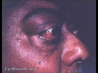exophthalmos: endocrine type