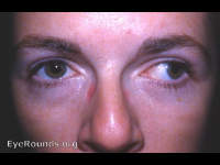 exotropia