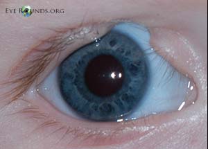 eyelid coloboma
