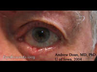 morpheaform basal cell carcinoma