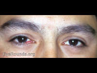 viral papilloma