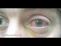 traumatic endophthalmitis