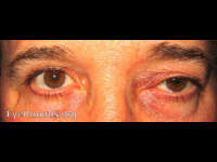 orbital lymphoma