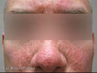 tuberous sclerosis