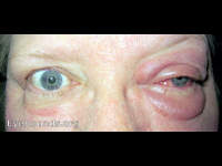 orbital myositis (inflammatory pseudotumor)