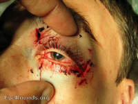 orbital fractures and trauma
