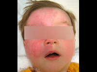 Sturge-Weber Syndrome