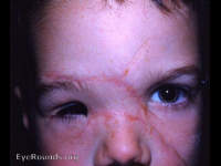 facial (including lids) scarring with distortion from auto accident