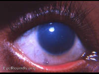 familial corneal dystrophy