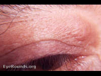 herniated orbital fat
