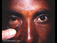 herniated orbital fat