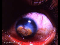 fatty degeneration of the cornea