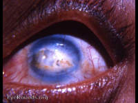 fatty and calcareous degeneration of the cornea