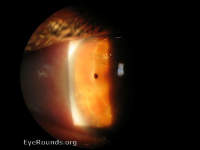 corneal foreign body
