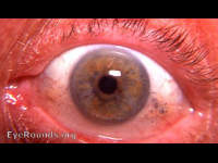 multiple old bulbar conjunctival foreign bodies