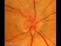 non-arteritic anterior ischemic optic neuropathy (NAION)