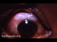 succulent filtering bleb following glaucoma surgery