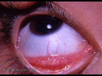 allergic conjunctivitis