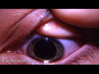 foreign body - conjunctiva upper lid