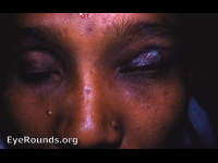 left frontal sinusitis with draining fistula