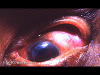 von Graefe incision in cataract surgery - an historical note