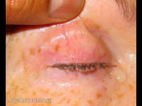 superglue in the eye