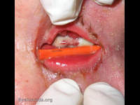 buccal mucosa patch graft