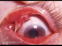 granuloma pyogenicum