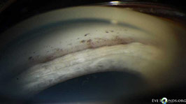 Grants syndrome, gonioscopy photograph