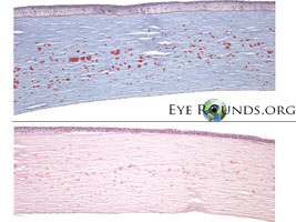 Granular Dystrophy