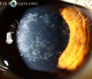 Granular corneal dystrophy, type 1