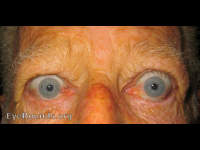 Graves' Ophthalmopathy
