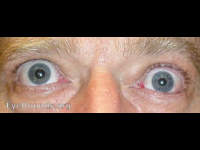 thyroid eye disease (Graves' Ophthalmopathy)