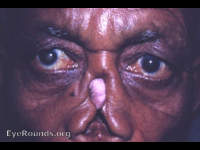 Syphilis and trachoma: tertiary syphilis with gumma distruction of nose also s-curve of right upper lid due to trachoma.