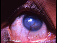 Leukomatous cornea heavy neovascularization