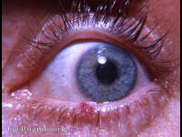 hemangioma of lid margin