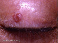 hemangioma of lid