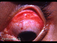 acute hemorrhagic conjunctivitis